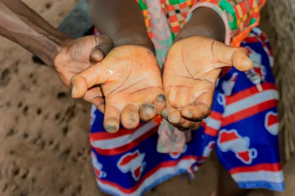 Lèpre : explorer les causes et les solutions efficaces